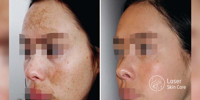 Before and After of Acne treatment
