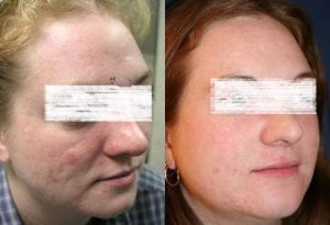 Before and After of Acne Scar Removal