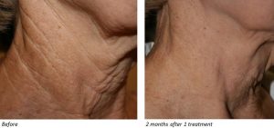 Before and After of Fractional CO2 Laser