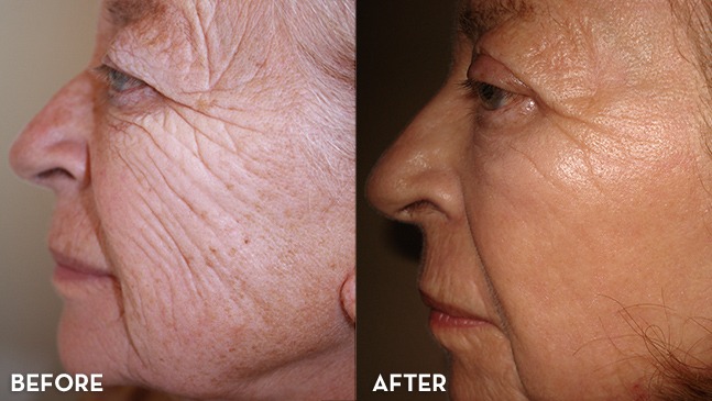 Before and After of Fractional CO2 Laser