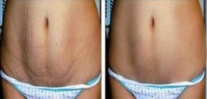 Before and After Results of Laser Stretch Mark Removal in Dubai