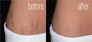 Before and After Results of Laser Stretch Mark Removal in Dubai