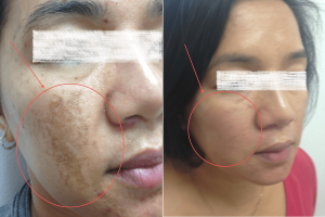 Before and After of Melasma Treatment