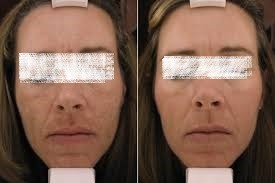 Before and After of Melasma Treatment