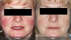 Before and After of Rosacea Treatment