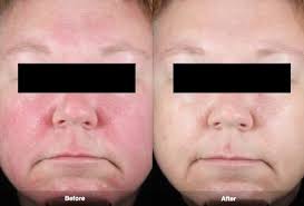 Before and After of Rosacea Treatment