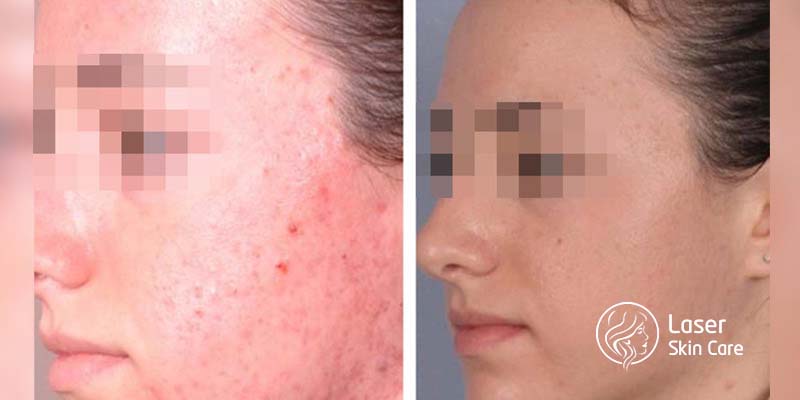Before and After of Acne treatment