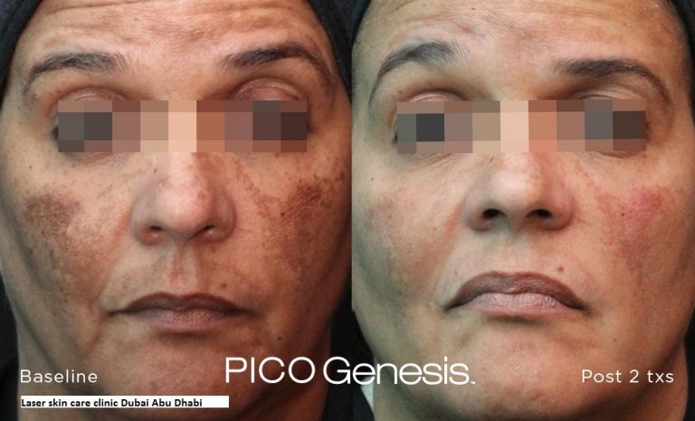 Enlighten PICO Genesis Before and After