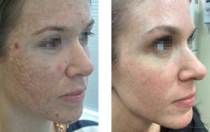 Laser Skin Resurfacing Before and After