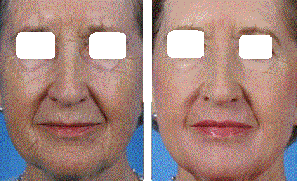 Laser Skin Resurfacing Before and After