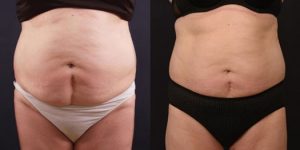 Fat Reduction Treatment Results