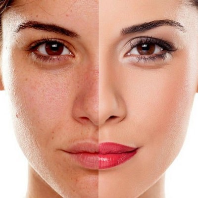 Microdermabrasion-Treatment-Cost-In-Dubai